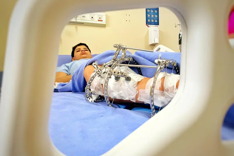 Malformações nos membros podem comprometer o desenvolvimento motor e funcional da criança