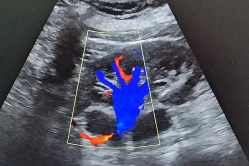 Imagem de exame de ultrassonografia com doppler