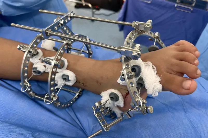 notícia:  Hospital Galileu é referência no tratamento cirúrgico do pé torto congênito 