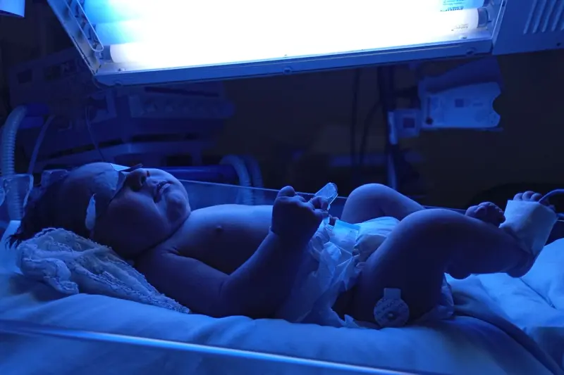 notícia: Como fototerapia, oferecida no Hospital da Transamazônica, ajuda a salvar recém-nascidos