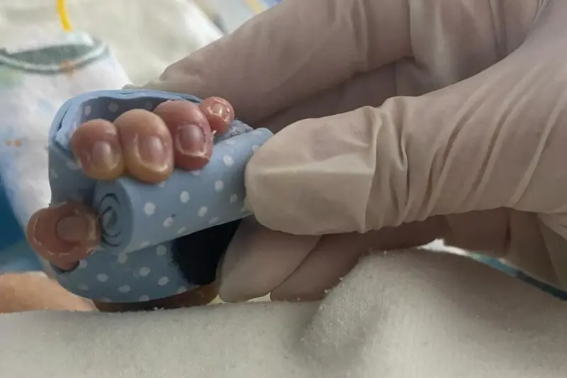 notícia: Hospital de Clínicas é pioneiro na região Norte com curso de órteses termomoldáveis